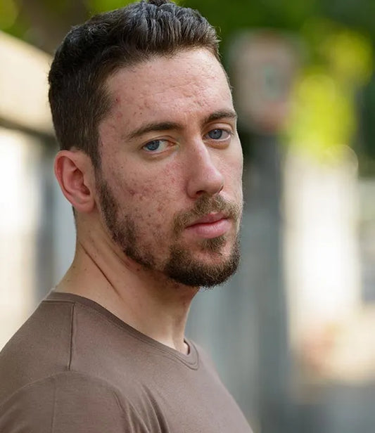 man with acne scarring on face