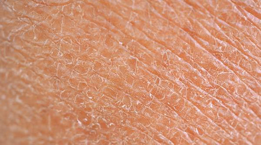 Athlete's Foot vs Dry Skin: What's the Difference?