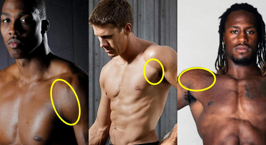 stretch marks on male celebrity's body like Dwight Howard