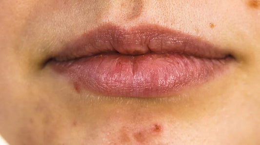 mens acne near mouth