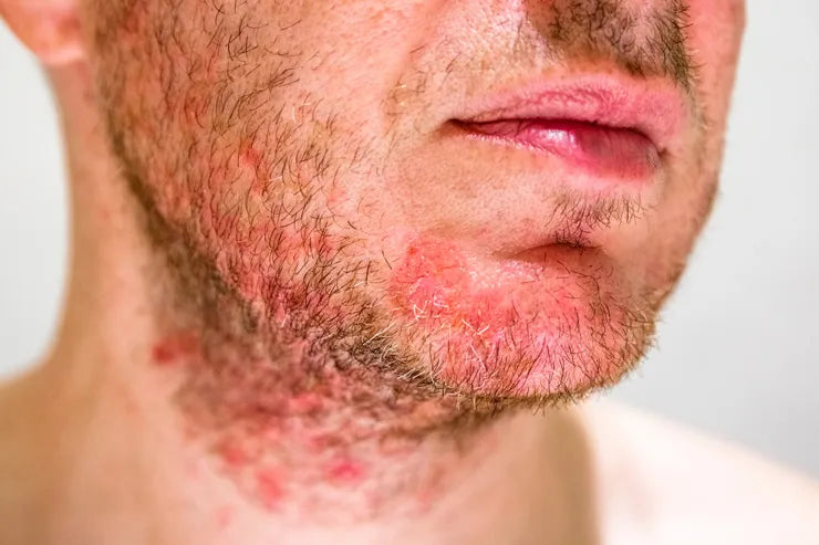 man with acne and red spots on neck