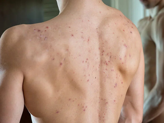 man with acne on back