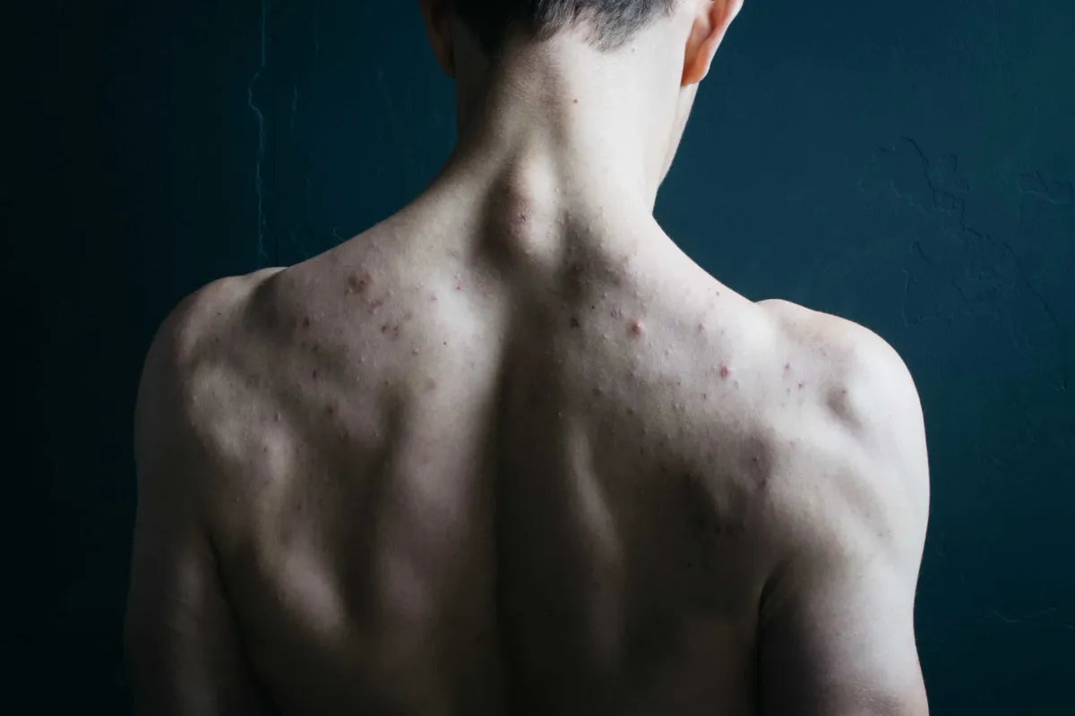 muscular man with acne on back, shoulders, and neck