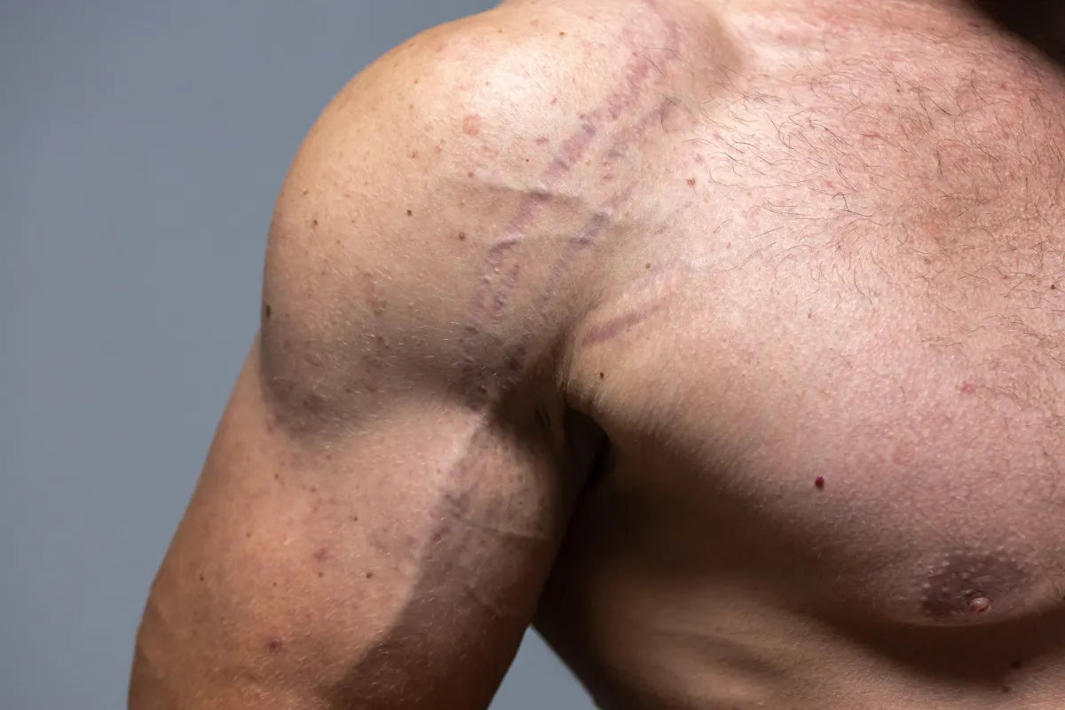 muscular man with stretch marks on bicep and shoulder