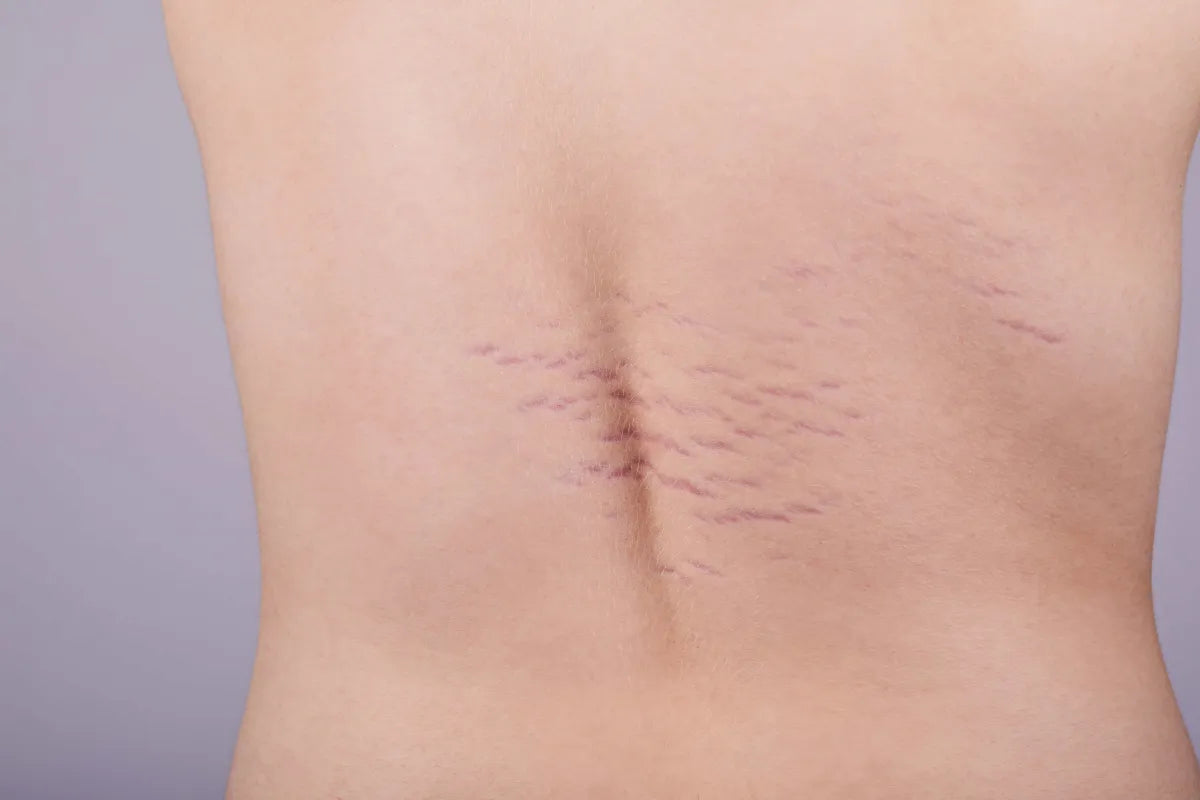 man with red stretch marks on lower back, striae gravidarum