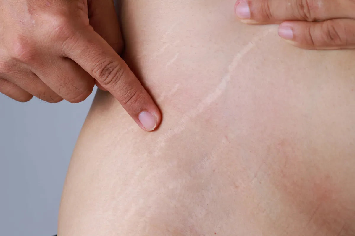 man with stretch marks on waist, pointing to stretch marks with finger, stretch marks caused by weight gain