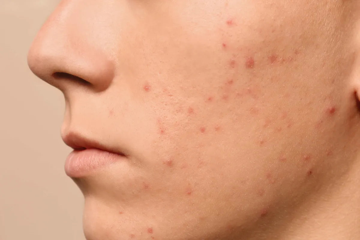 man with facial acne, red acne on checks and near mouth, acne scars